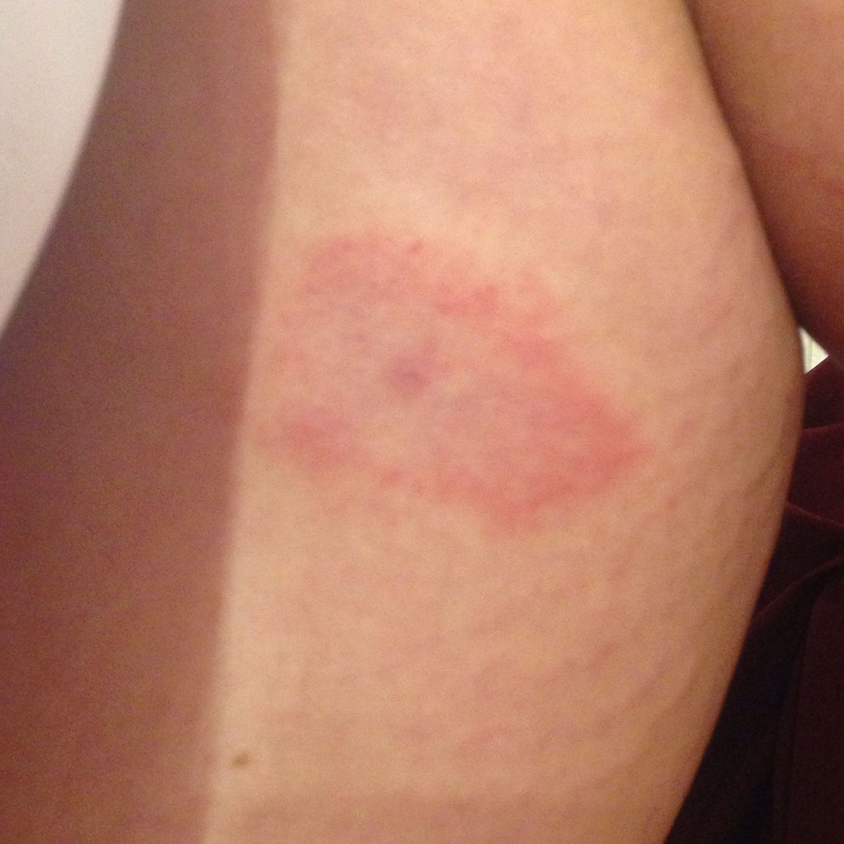 Muss man wegen einer geröteten Schwellung auf einem Zeckenbiss zum arzt Muss man wegen einer geröteten Schwellung auf einem Zeckenbiss zum arzt