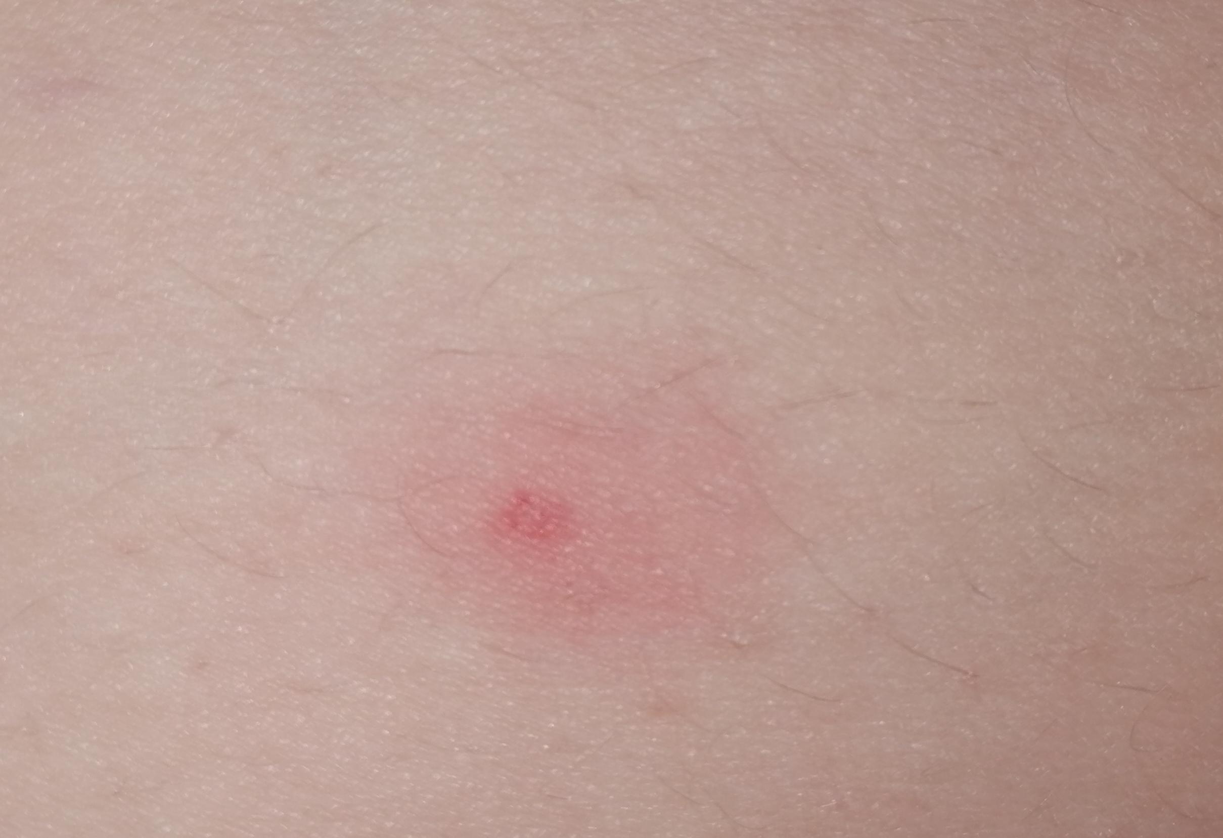 Zeckenbiss Rötung? (Gesundheit und Medizin, Angst, Zecken) Zeckenbiss Rötung? (Gesundheit und Medizin, Angst, Zecken)