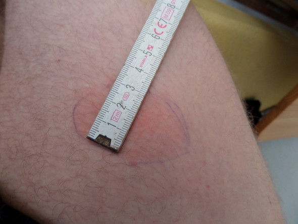 Zeckenbiss 2 Wochen Her Aber Anderer Stelle Ist Das Eine Wanderrote Borreliose Zeckenbiss 2 Wochen Her Aber Anderer Stelle Ist Das Eine Wanderrote Borreliose
