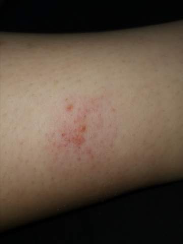 Zeckenbiss Gerotet Was Tun Gesundheit Und Medizin Notfall Zecken Zeckenbiss Gerotet Was Tun Gesundheit Und Medizin Notfall Zecken