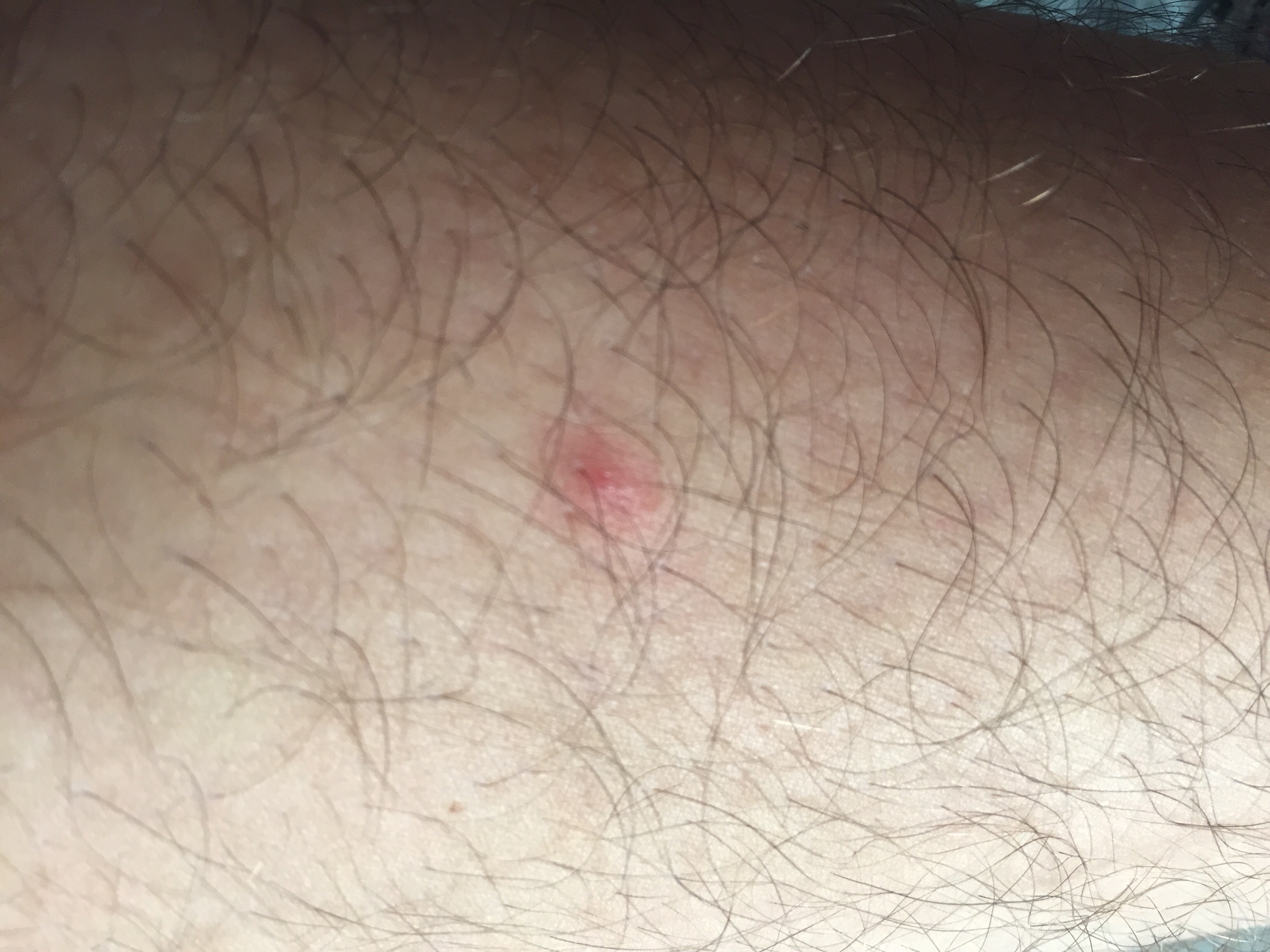 Zeckenbiss Grund zur Sorge (Bild)? (Gesundheit, Zecke)