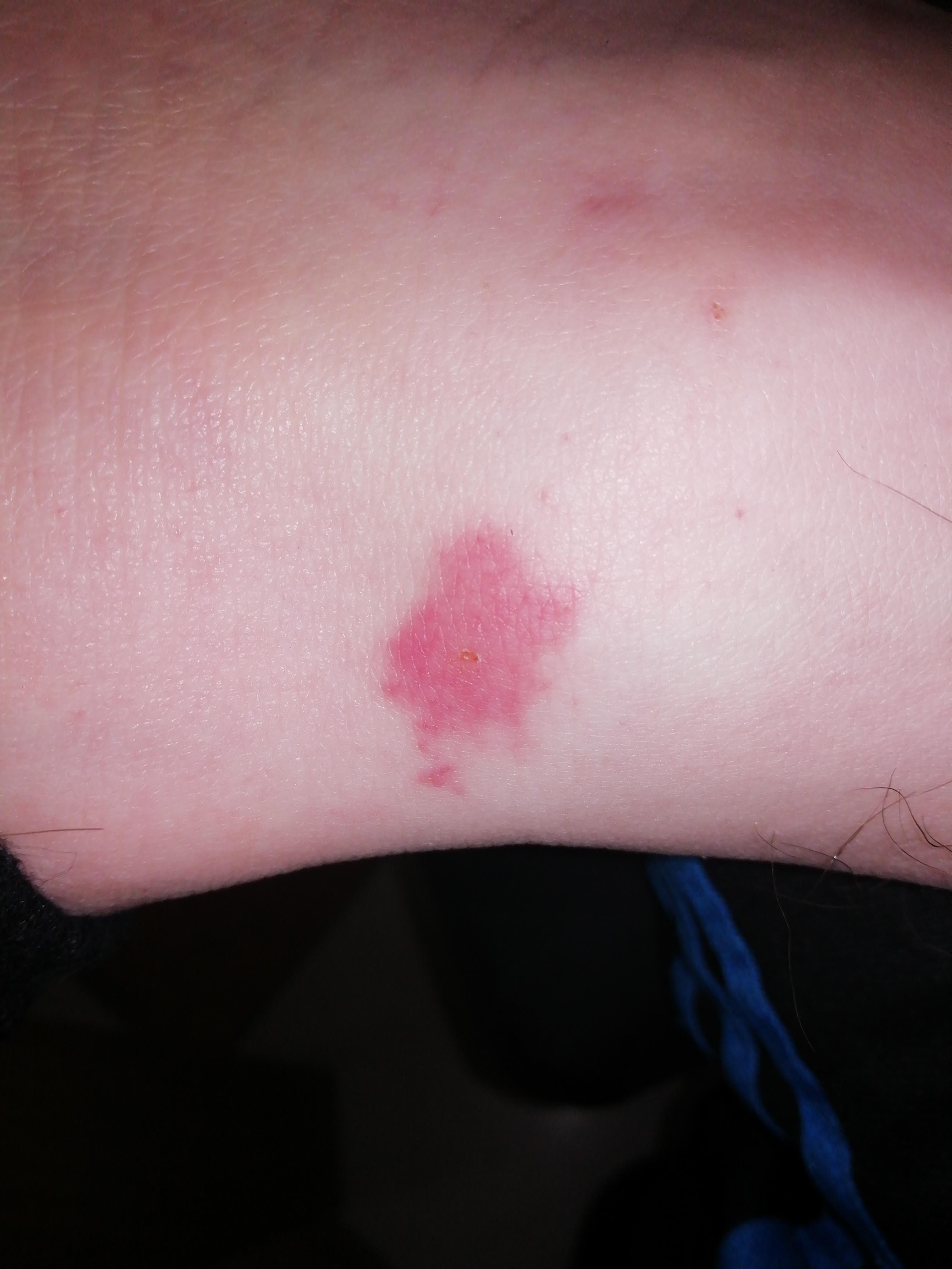Hilfee Zeckenbiss Hilfee? (Insekten, Zecken, Borreliose)