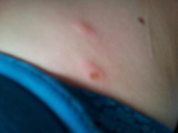 Zeckenbiss Juckt Wann Zum Arzt Gesundheit Zecke Zeckenbiss Juckt Wann Zum Arzt Gesundheit Zecke