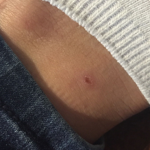 Zeckenbiss juckt ziemlich? (Gesundheit, Zecken)