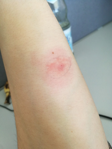 Zeckenbiss Nach Einer Woche Sollte Ich Zum Arzt Gesundheit Und Medizin Gesundheit Zecken Zeckenbiss Nach Einer Woche Sollte Ich Zum Arzt Gesundheit Und Medizin Gesundheit Zecken