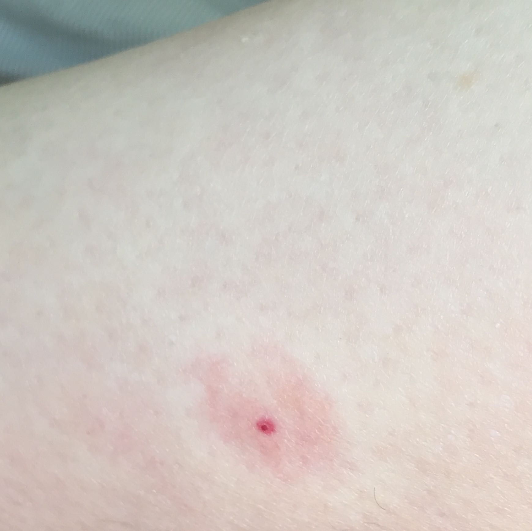 Zeckenbiss Horror Infektion In Nur 15 Minuten Baby Lily 5 Monate Von Zecke Gebissen Was Jetzt Geschah Ist Unfassbar - grwkl5i