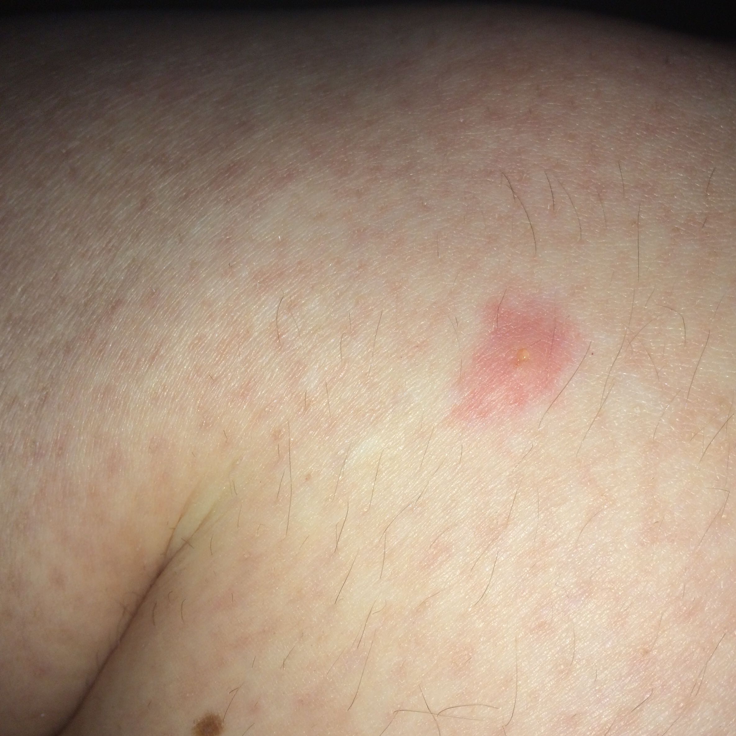 Zeckenbiss Ist die Rötung normal? (Gesundheit und Medizin, Arzt, Haut) Zeckenbiss Ist die Rötung normal? (Gesundheit und Medizin, Arzt, Haut)