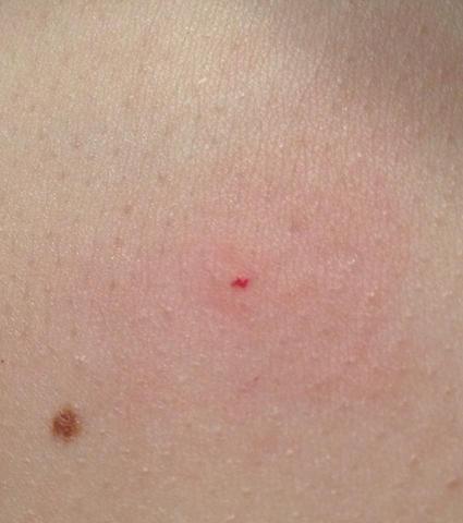 Zeckenbiss Roter Punkt Gesundheit Angst Zeckenbiss Roter Punkt Gesundheit Angst