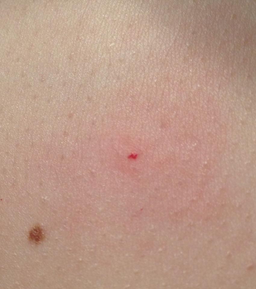 Zeckenbiss? Roter Punkt… (Gesundheit, Angst) Zeckenbiss? Roter Punkt… (Gesundheit, Angst)