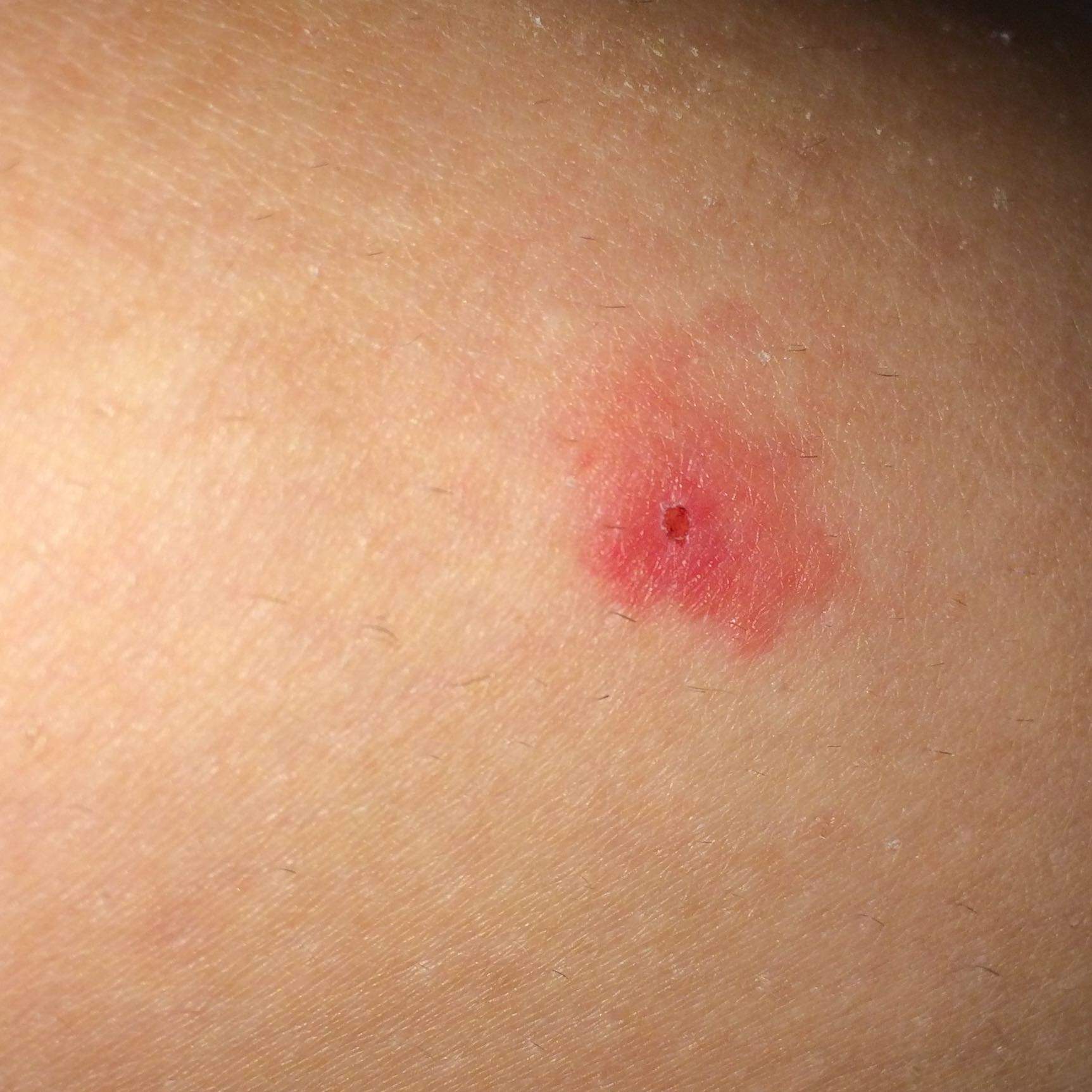 Zeckenbiss - Stelle gerötet, soll ich damit zum Arzt? (Gesundheit