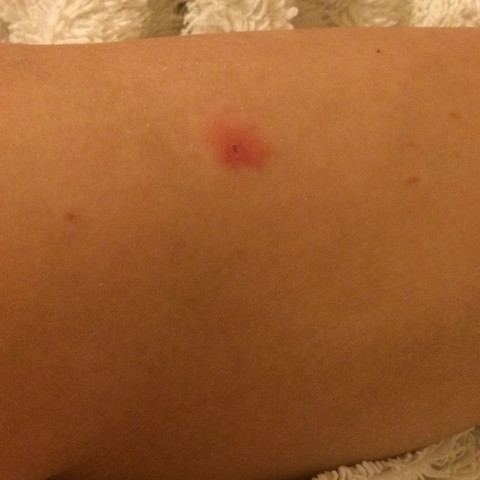 Zeckenbiss Stelle Gerotet Soll Ich Damit Zum Arzt Gesundheit Entzundung Zecken Zeckenbiss Stelle Gerotet Soll Ich Damit Zum Arzt Gesundheit Entzundung Zecken