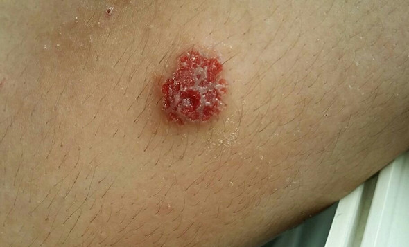 Februar 2017 (Unterarm) - (Krankheit, Haut, Verletzung)