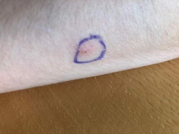 Zeckenkopf Stecken Geblieben Gesundheit Und Medizin Zeckenbiss Zeckenkopf Stecken Geblieben Gesundheit Und Medizin Zeckenbiss