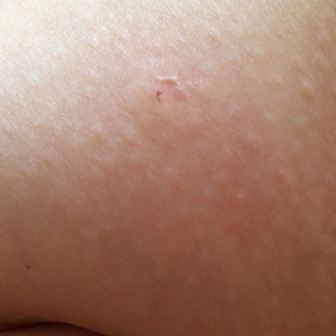 Zeckenkopf Steckt Im Bein Tiere Arzt Beine Zeckenkopf Steckt Im Bein Tiere Arzt Beine