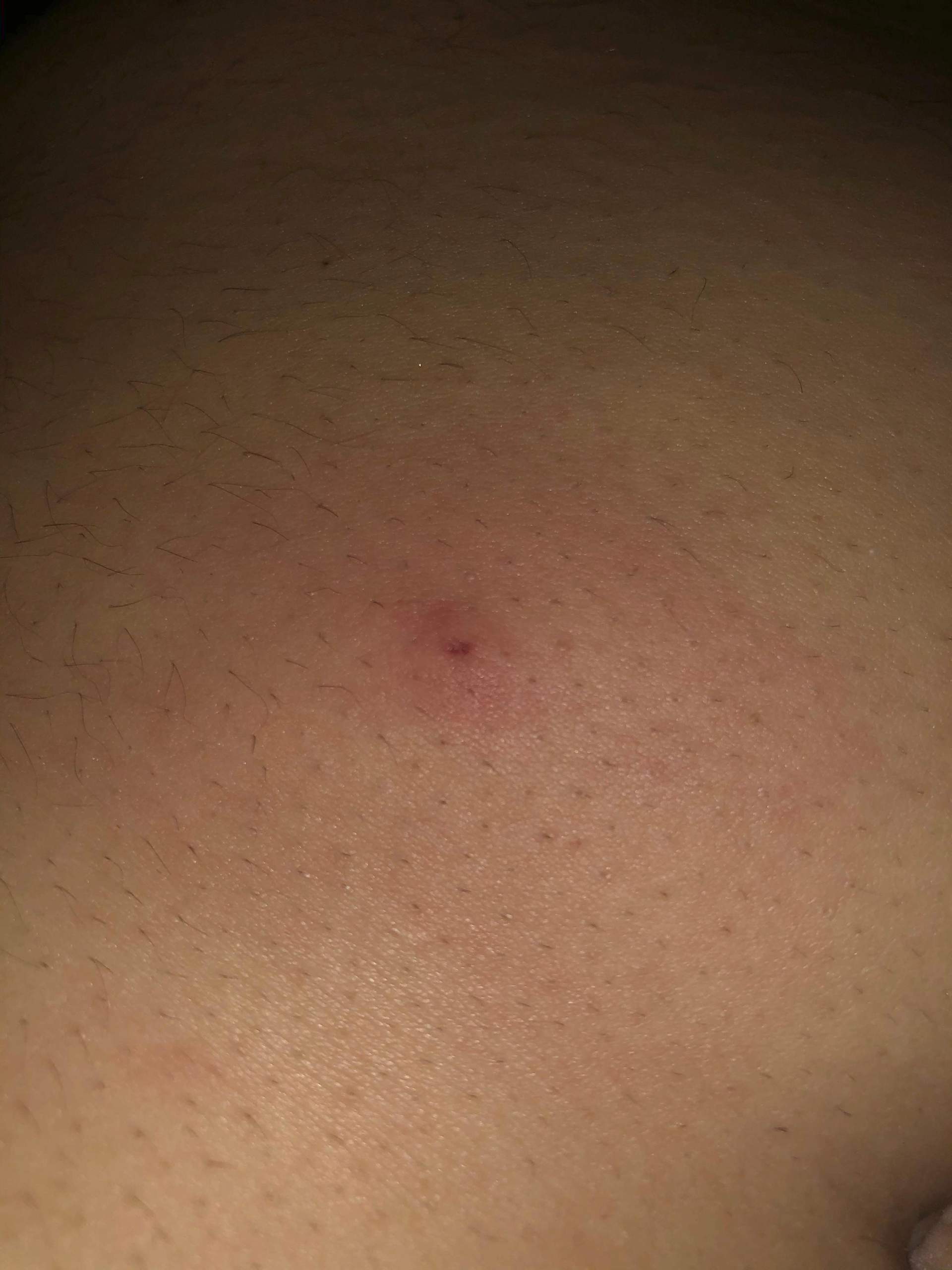 Zeckenstich Juckt Gesundheit Und Medizin Gesundheit Haut Zeckenstich Juckt Gesundheit Und Medizin Gesundheit Haut