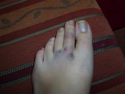 Zeh Doch Gebrochen Und Nun Probleme Arzt Fusse Knochen Zeh Doch Gebrochen Und Nun Probleme Arzt Fusse Knochen