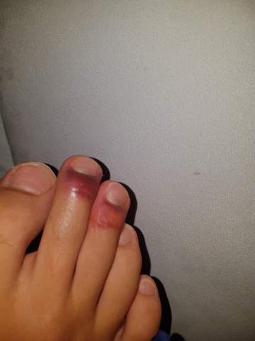 Zeh Gebrochen Nach Treppe Foto Gesundheit Und Medizin Sport Arzt Zeh Gebrochen Nach Treppe Foto Gesundheit Und Medizin Sport Arzt