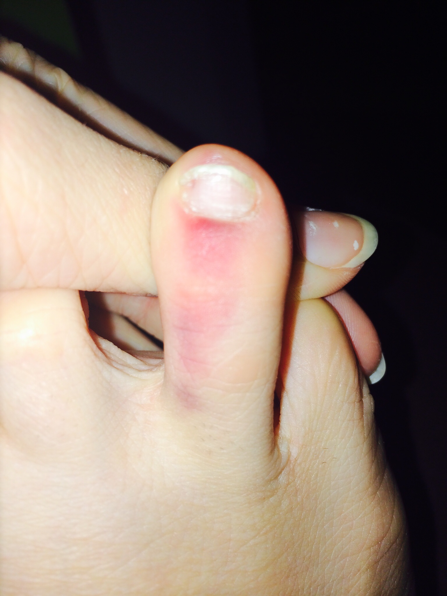 Kleine Fuss Zehe Gebrochen Erkennen Ob Ein Zeh Gebrochen Ist 11