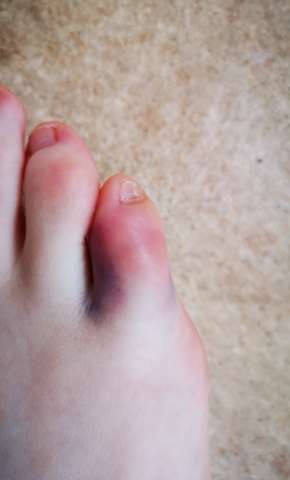 Zeh Ist Blau Und Tut Weh Gebrochen Arzt Schmerzen Bluterguss Zeh Ist Blau Und Tut Weh Gebrochen Arzt Schmerzen Bluterguss