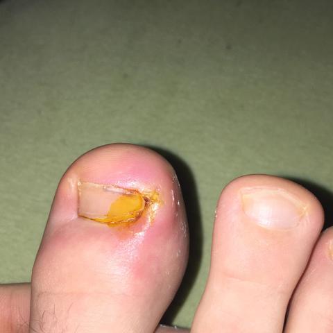 Zeh nach Einwachsen entzündet (Gesundheit, Füße)