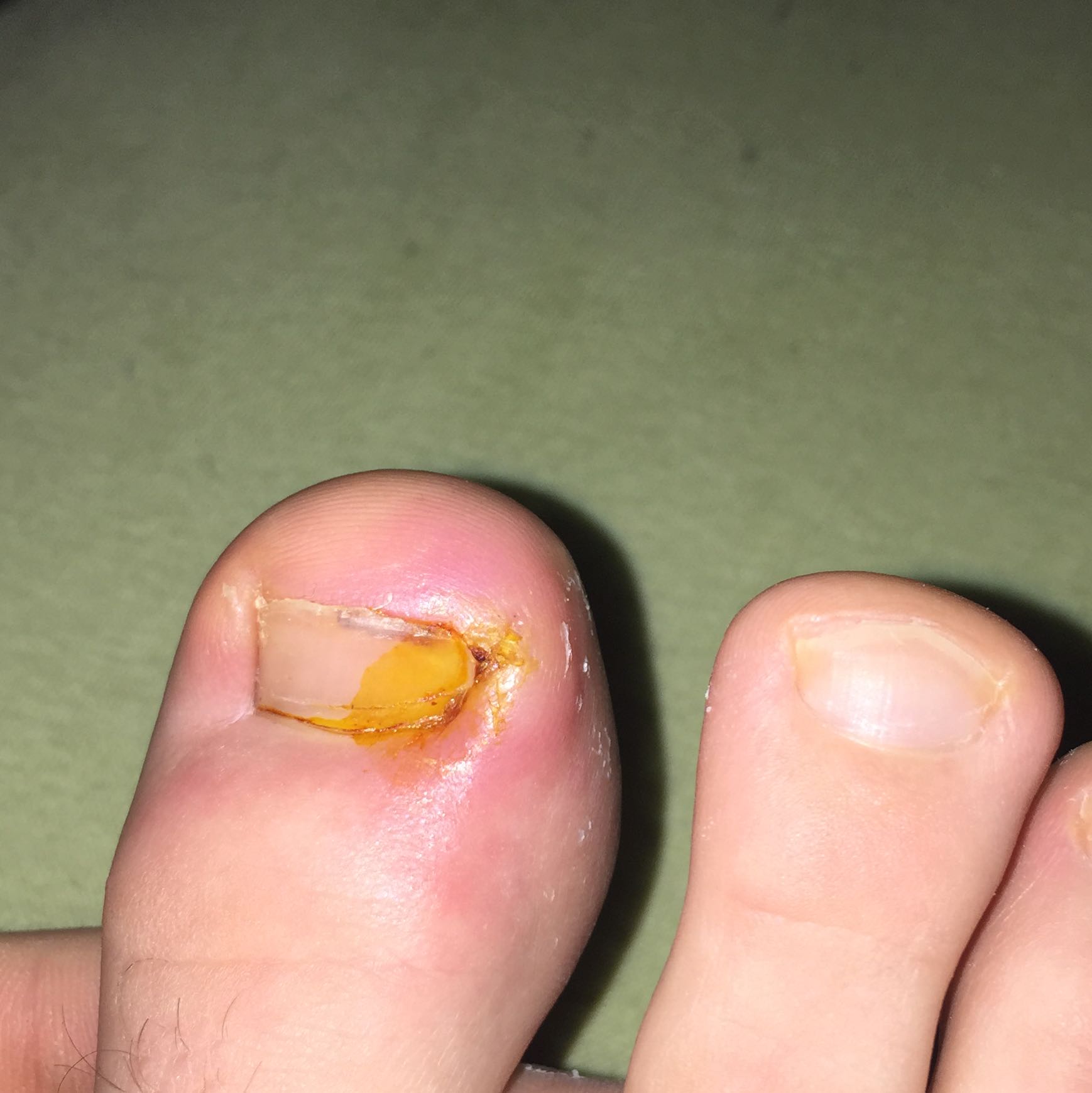 Zeh nach Einwachsen entzündet (Gesundheit, Füße) Zeh nach Einwachsen entzündet (Gesundheit, Füße)