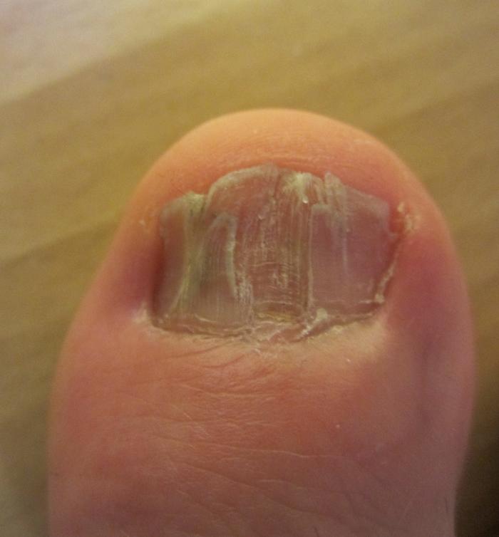 Herzerwärmend Großer Zeh Schmerzt Am Nagel Naegel Wachsen Einfach Nicht Shellac Set Herzerwärmend Großer Zeh Schmerzt Am Nagel Naegel Wachsen Einfach Nicht Shellac Set