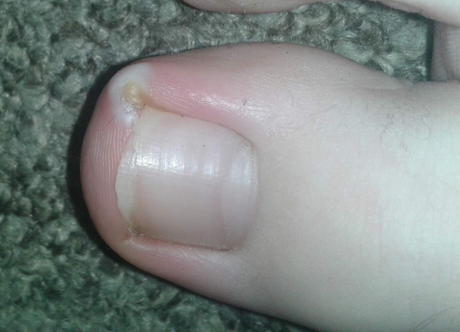 Zehennagel Eingewachsen Was Tun Gesundheit Schmerzen Fusse Zehennagel Eingewachsen Was Tun Gesundheit Schmerzen Fusse