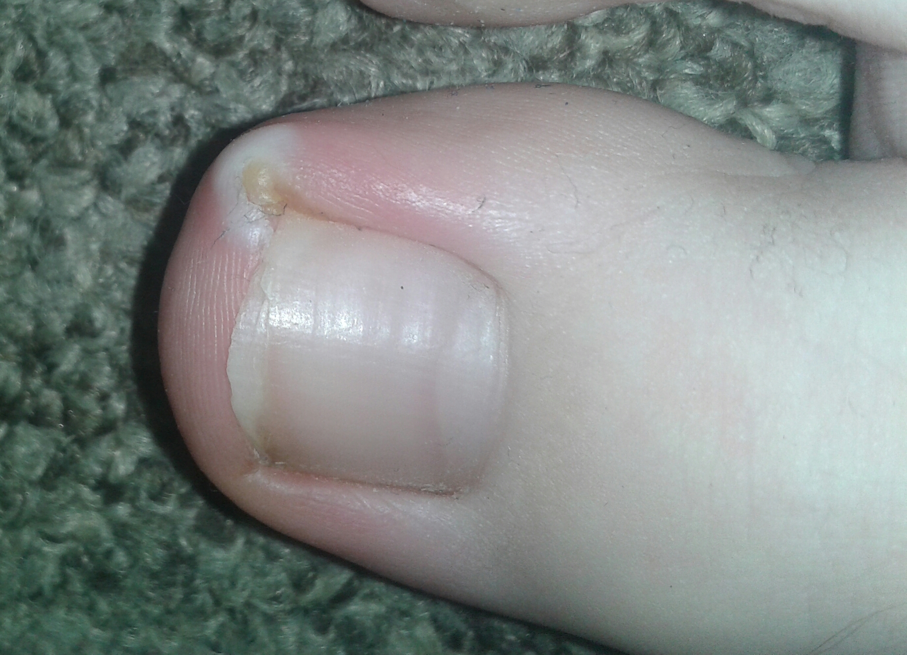 Zehennagel eingewachsen was tun? (Gesundheit, Schmerzen, Füße) Zehennagel eingewachsen was tun? (Gesundheit, Schmerzen, Füße)