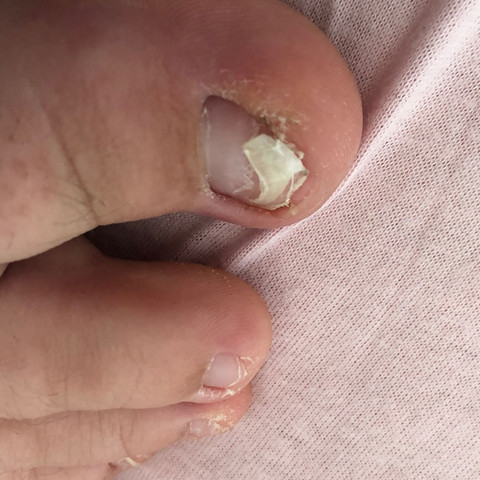 Zehennagel Lost Sich Nach Operation Was Bedeutet Das Gesundheit Und Medizin Ratlos Zehennagel Lost Sich Nach Operation Was Bedeutet Das Gesundheit Und Medizin Ratlos