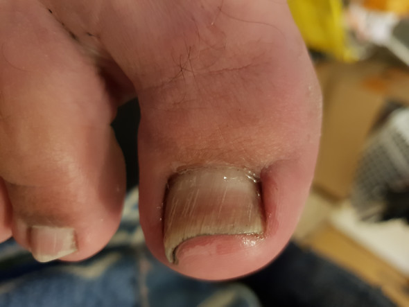 Zehennagel Verfarbt Poros Und Verdickt Aber Keine Pilzerkrankung Zehennagel Verfarbt Poros Und Verdickt Aber Keine Pilzerkrankung