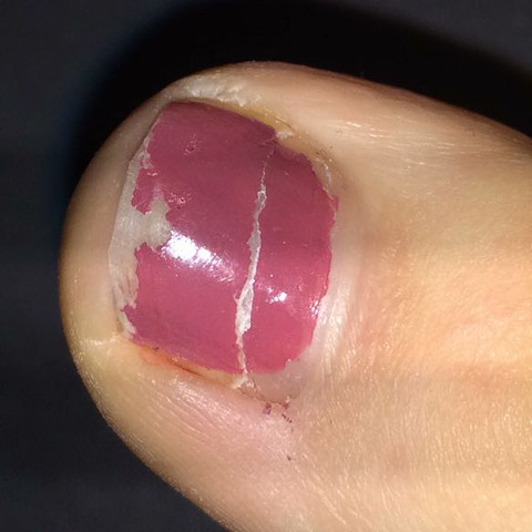 Zehnagel Lost Sich Zur Halfte Und Hangt Noch An 1 3 Gesundem Nagelbett Was Tun Gesundheit Und Medizin Arzt Schmerzen Zehnagel Lost Sich Zur Halfte Und Hangt Noch An 1 3 Gesundem Nagelbett Was Tun Gesundheit Und Medizin Arzt Schmerzen