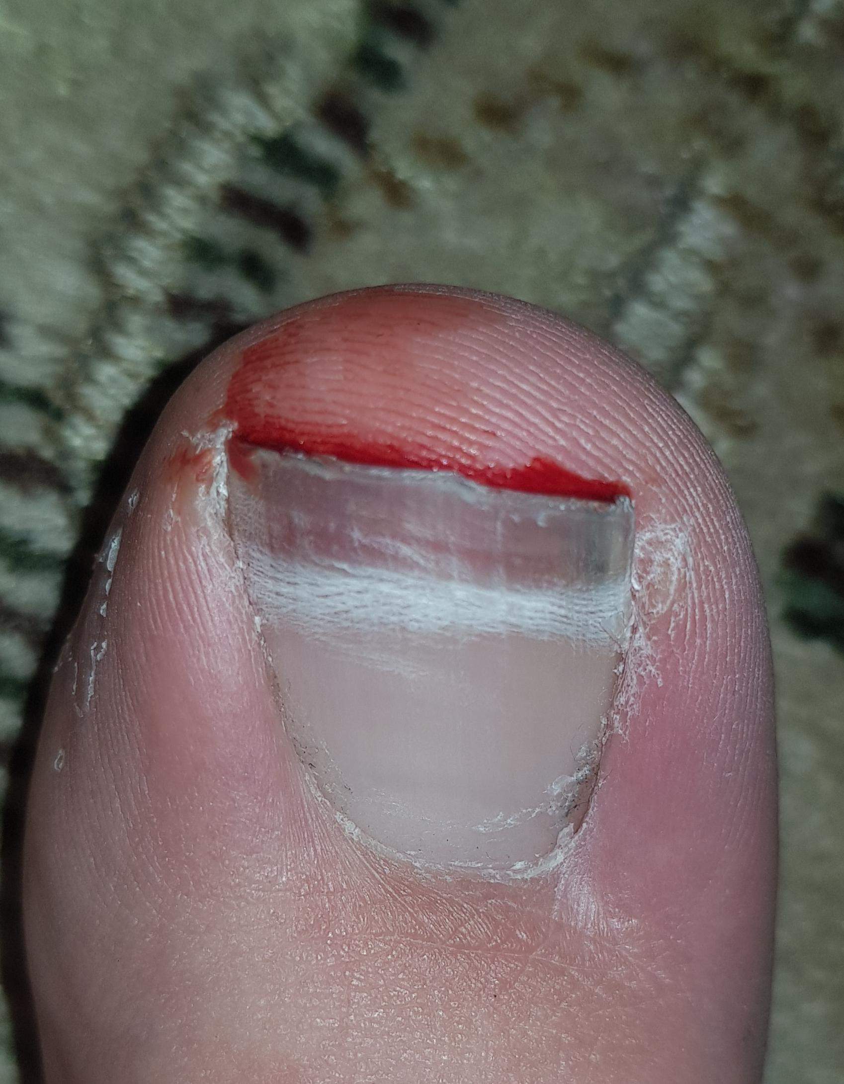 Zehnagel umgeknickt, was sollte ich jetzt tun? (Gesundheit, Schmerzen, Blut)