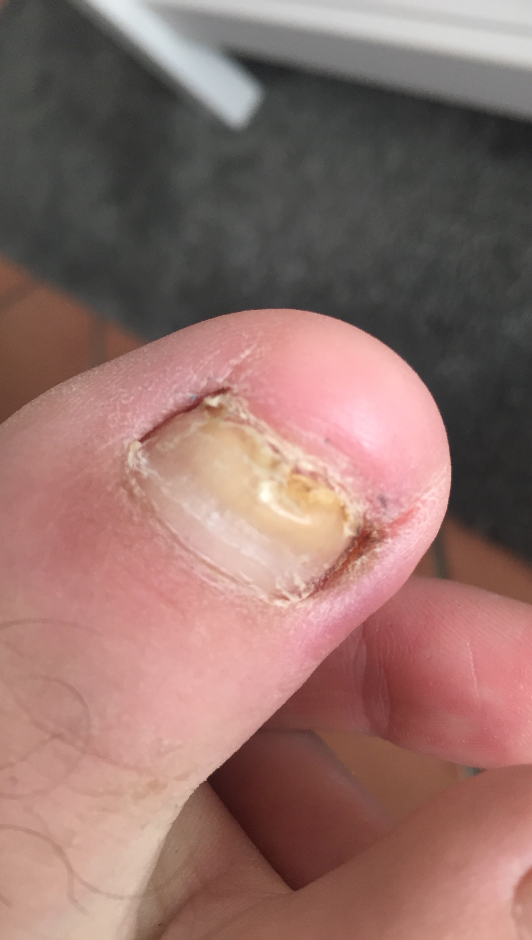 Zehnagel Wachst Nach Entfernung Nicht Sauber Nach Grosser Zeh Leicht Rotlich An Rechter Seite Gesundheit Medizin Zehennagel Zehnagel Wachst Nach Entfernung Nicht Sauber Nach Grosser Zeh Leicht Rotlich An Rechter Seite Gesundheit Medizin Zehennagel