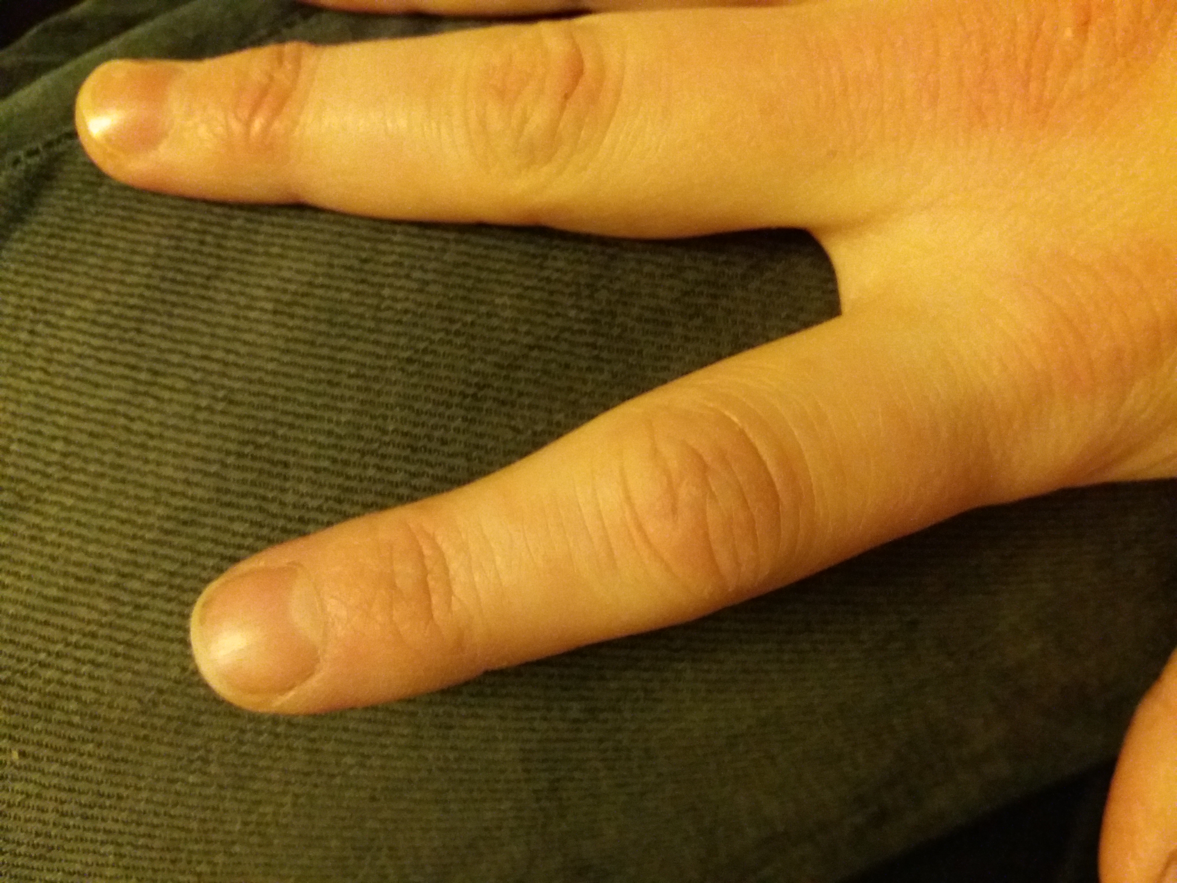 Wie Schaut Ein Gebrochener Finger Aus