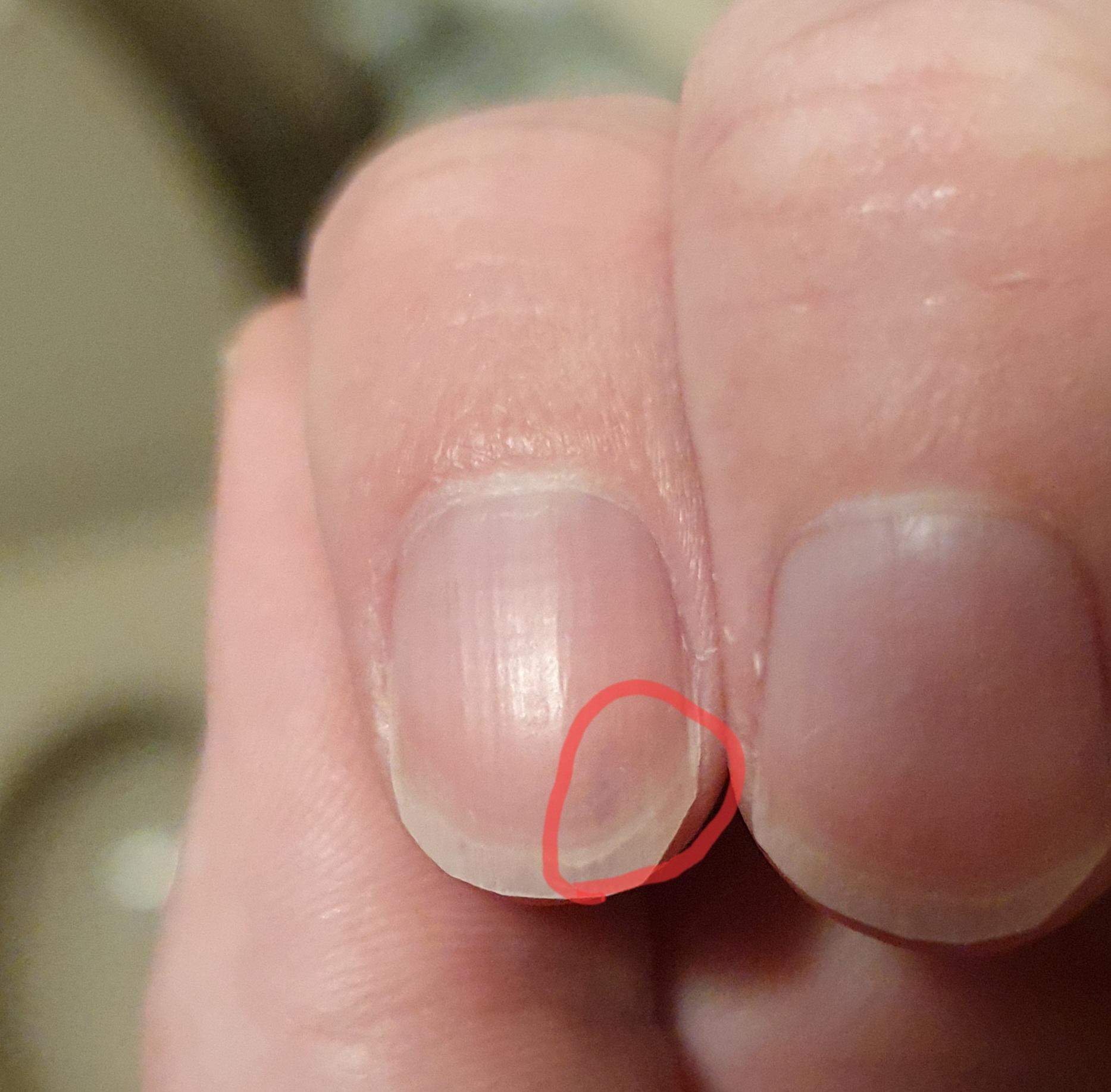 Finger In Autotür Eingeklemmt Nagel Blau Zeigefinger gestoßen, jetzt ist der Fingernagel blau? (Gesundheit