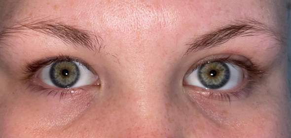 Zentrale Iris-Heterochromie? Oder gewöhnliche Augenfarbe?