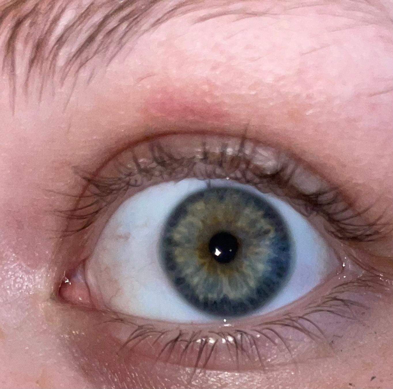 Zentrale Iris Heterochromie Oder Gew hnliche Augenfarbe gr n zentrale-iris-heterochromie-oder-gew-hnliche-augenfarbe-gr-n