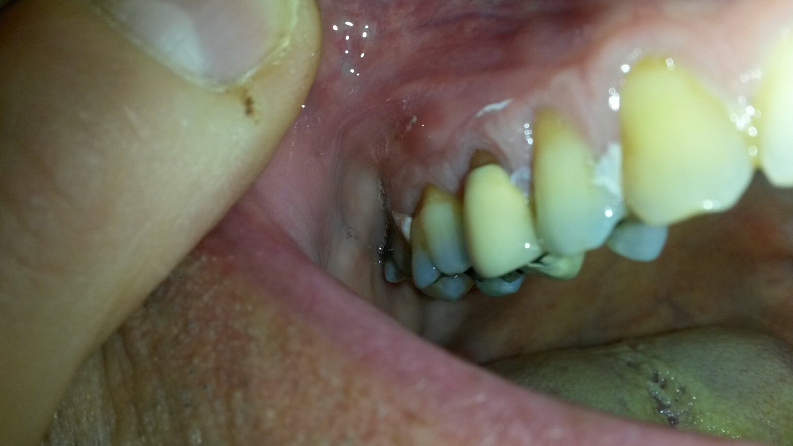 Wurzelentzündung Zahn Ziehen