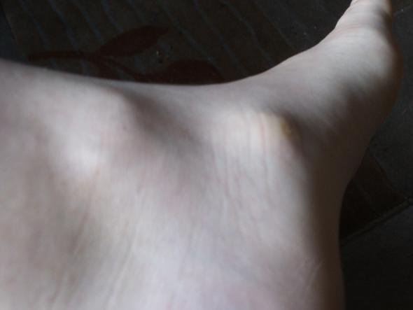 der linke raustehende Knochen st der normale Knöchel... - (Gesundheit, Füße, Knochen)