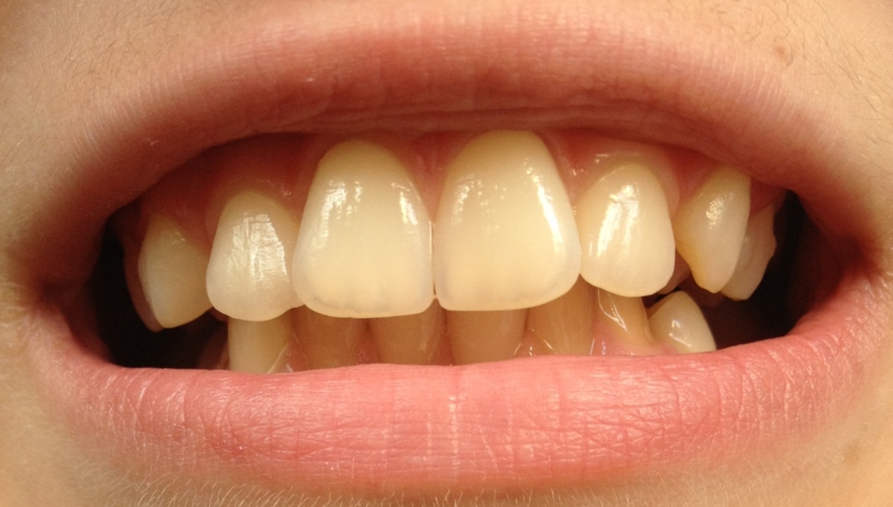 Zu gelb oder Normal? Diese Zähne. (Hygiene)