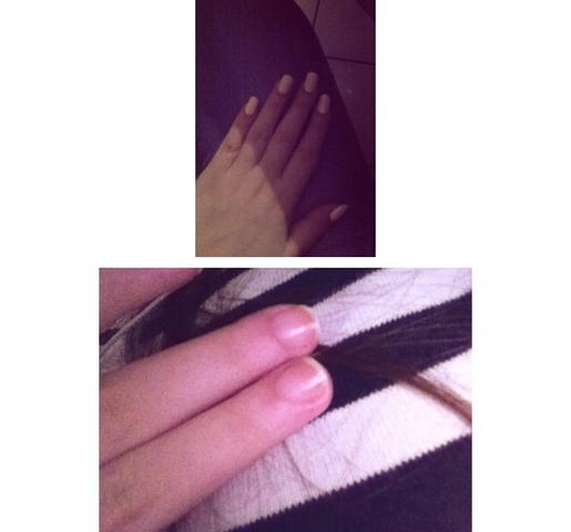Zu Kurzes Nagelbett Mit Bilder Gesundheit Manikure