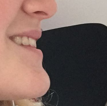 Zu Langes Kinn Hasslich Normal