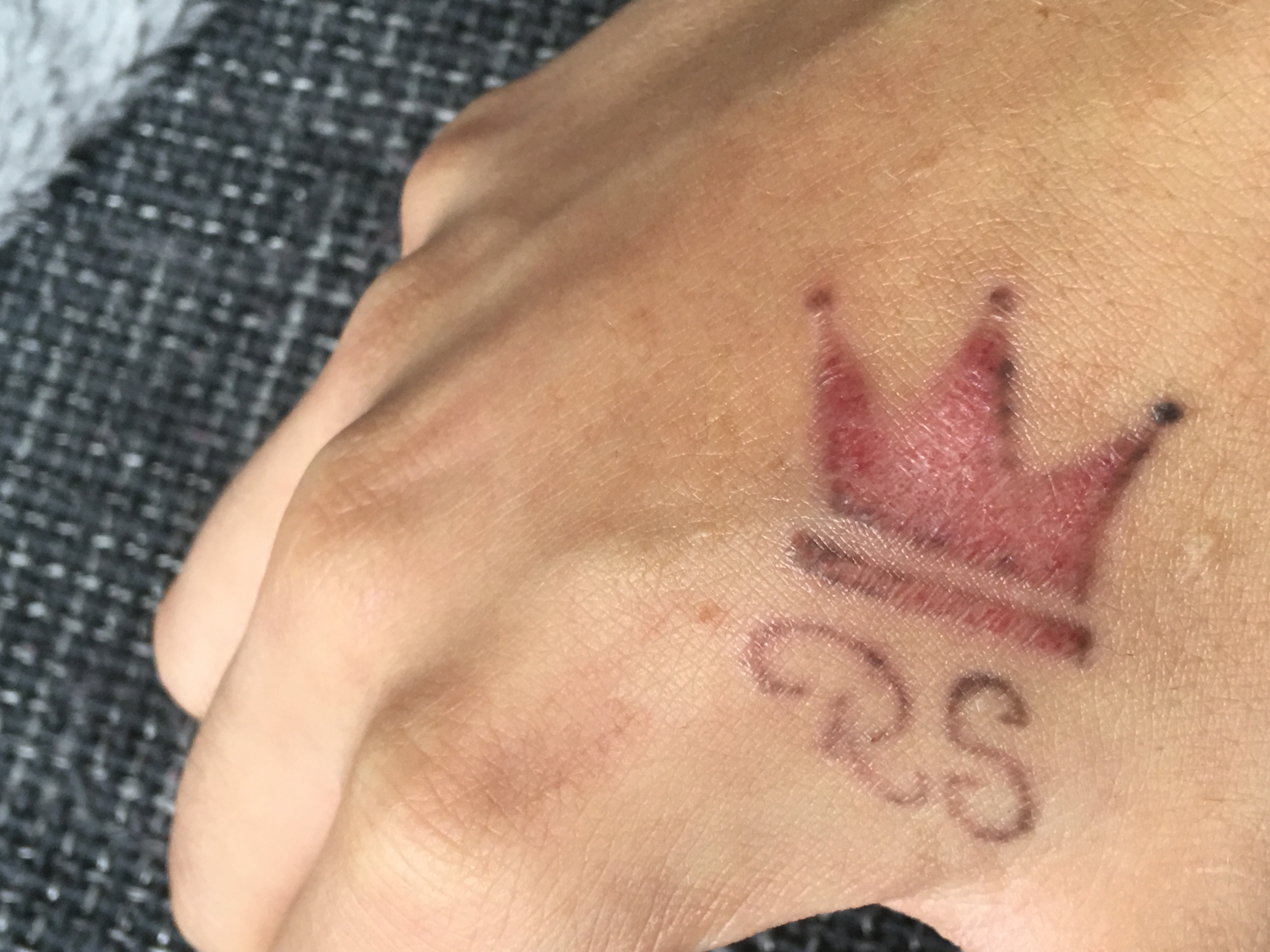 Zu tief gestochen ? (Haut, Tattoo)