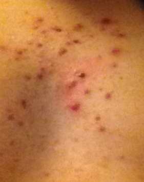 Zu viele Pickel und anderes auf der Brust... Sollte ich ...