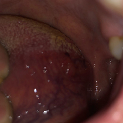 Was könnte das auf meiner Zunge sein ? So ein dunkler Punkt und dunkle Adern ? - (Gesundheit und Medizin, Zunge, Adern)