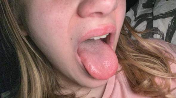  Zunge angeschwollen?