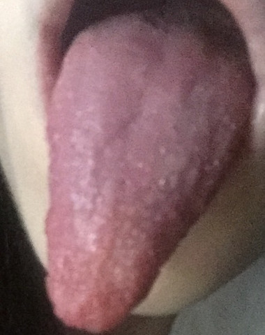 Zunge Brennt Wenn Ich Was Esse Medizin Essen Arzt Zunge Brennt Wenn Ich Was Esse Medizin Essen Arzt