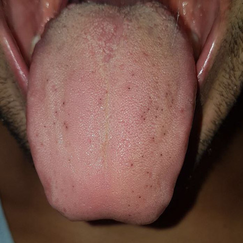 Zunge Flecken Bedeutung Gesundheit Und Medizin Medizin Krank Zunge Flecken Bedeutung Gesundheit Und Medizin Medizin Krank