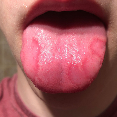 Zunge Hat Rote Stellen Was Tun Medizin Arzt Entzundung Zunge Hat Rote Stellen Was Tun Medizin Arzt Entzundung