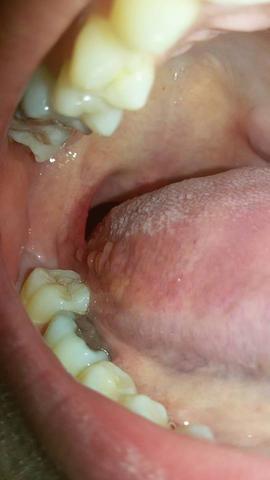 links - (Zunge, normal, Herpes)